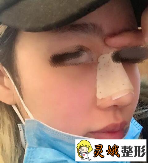 假体隆鼻前后对比之假体隆鼻案例，是仙女们想要的自然隆鼻果