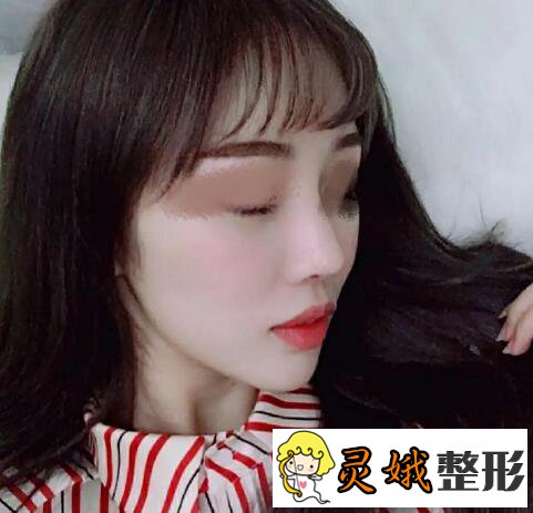 假体隆鼻前后对比之假体隆鼻案例，是仙女们想要的自然隆鼻果