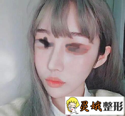 假体隆鼻前后对比之假体隆鼻案例，是仙女们想要的自然隆鼻果