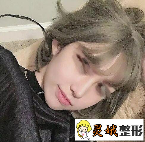 假体隆鼻前后对比之假体隆鼻案例，是仙女们想要的自然隆鼻果
