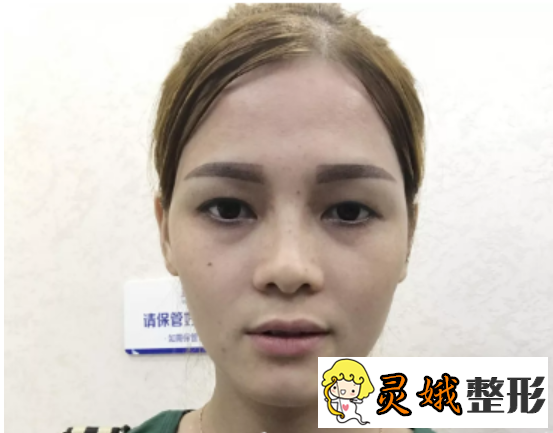 埋线双眼皮图片大全，术后恢复1-7天果图之埋线双眼皮案例