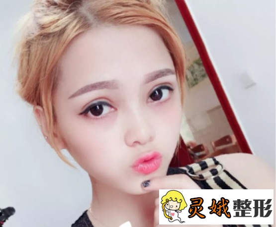 埋线双眼皮图片大全，术后恢复1-7天果图之埋线双眼皮案例