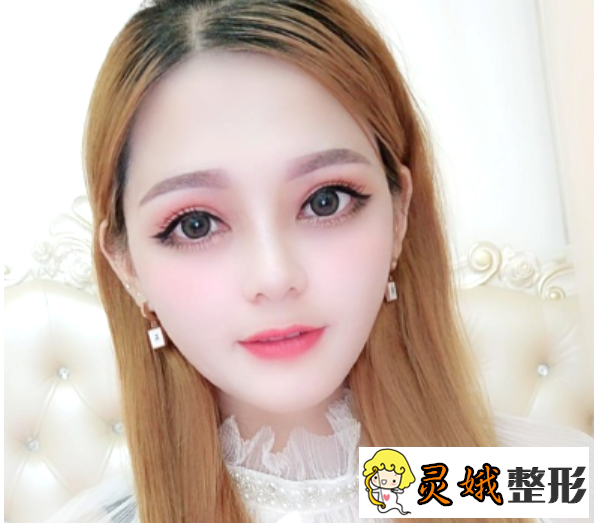 埋线双眼皮图片大全，术后恢复1-7天果图之埋线双眼皮案例
