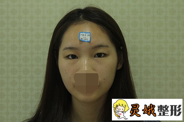 张娇娇医生，眼部整形专家