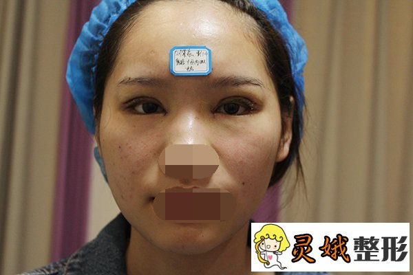 张娇娇医生，眼部整形专家