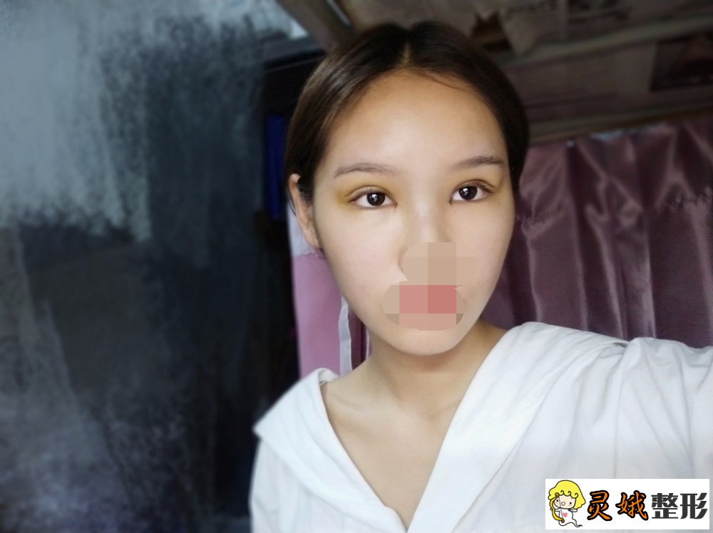张娇娇医生，眼部整形专家
