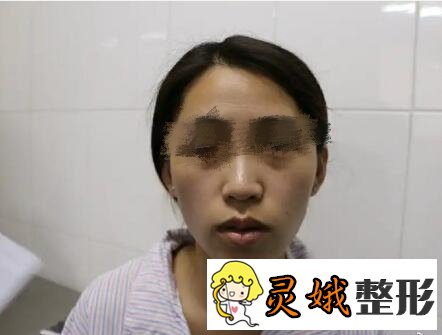 面部填充术前