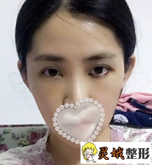 面部填充术后三天