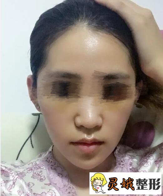 面部填充术后半个月