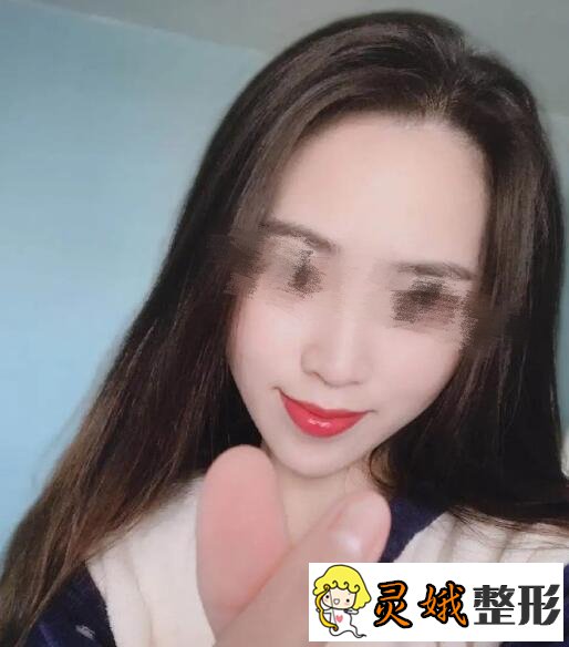 面部填充术后2个月