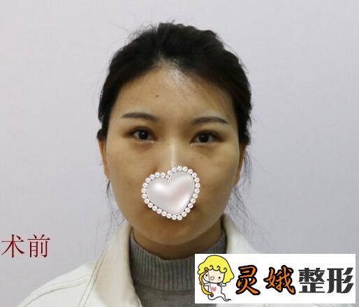 填充术前