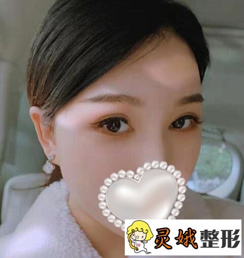 填充术后一个月