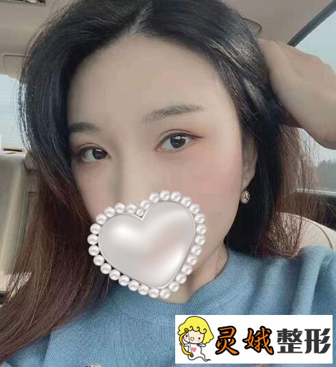 填充术后三个月