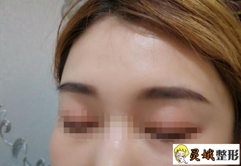 纹眉后的恢复过程