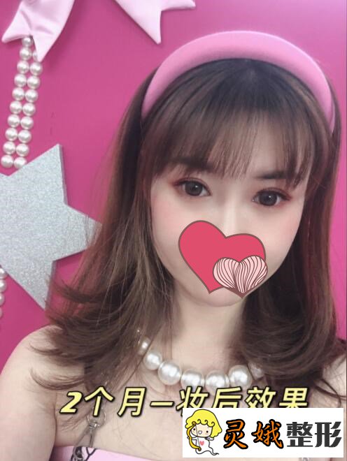 中山爱思特整形朱占魁医生开眼角手术后2个月