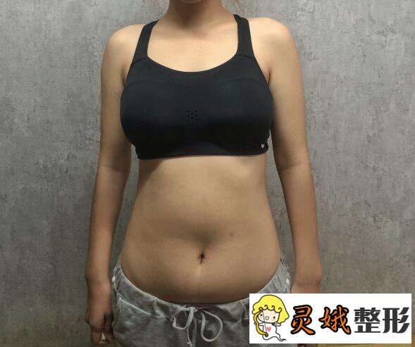 汕头华美整形医院朱洙玉医生吸脂瘦身前