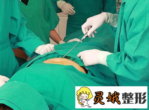 汕头华美整形医院朱洙玉医生吸脂瘦身中