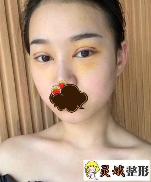 割双眼皮术后