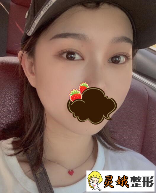 割双眼皮术后1个月