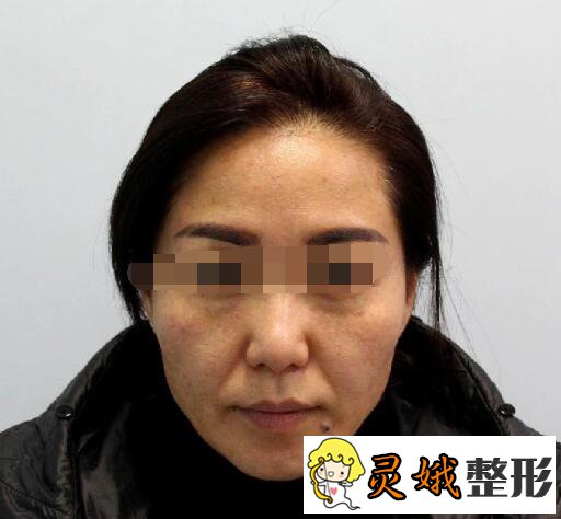 玻尿酸除皱前