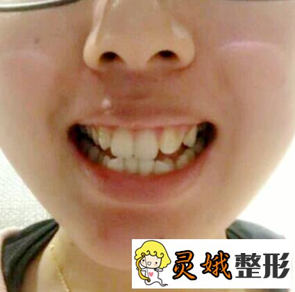 牙齿矫正果