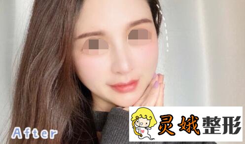 方跃明医生玻尿酸丰太阳穴果