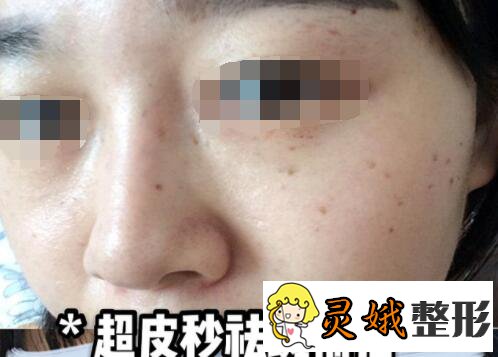 高玉洁医生祛斑案例前