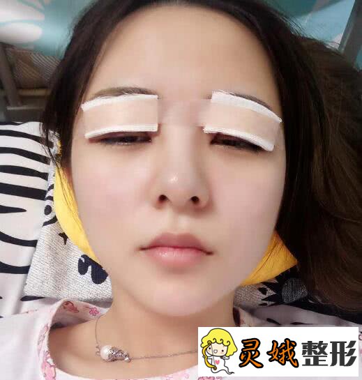 修复双眼皮以后得恢复过程