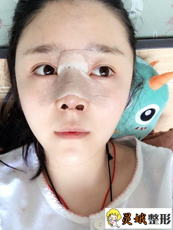 八大处王欢肋骨鼻子怎么样?隆鼻案例