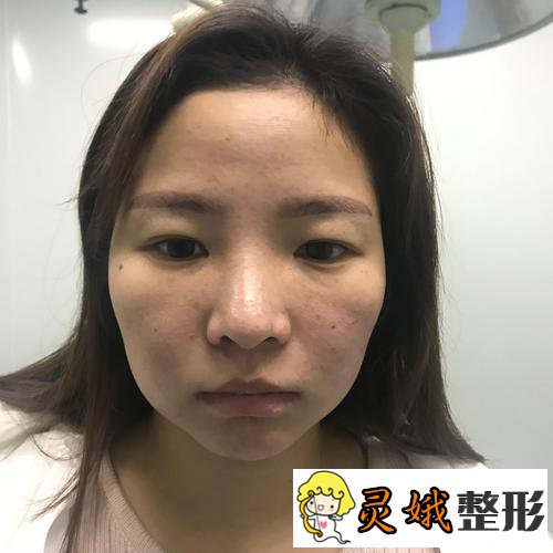 崔荣达医生颧骨内推案例