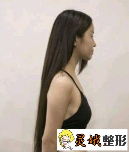 娜高假体隆胸果好不好?娜高假体隆胸案例