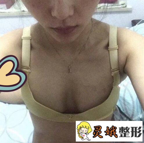 娜高假体隆胸果好不好?娜高假体隆胸案例