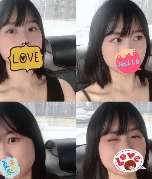 兰州大学第二医院眼科陈盛举近视矫正反馈，从此视野不再“模糊”！