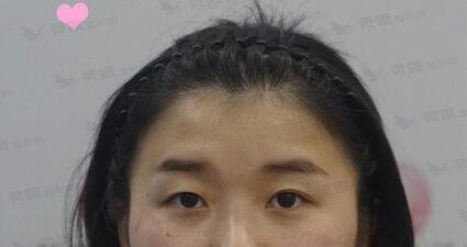 西南医院整形科陈亮双眼皮怎么样？术后案例30天遇见“美眼”