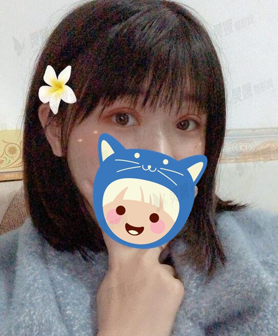 西南医院整形科陈亮双眼皮怎么样？术后案例30天遇见“美眼”