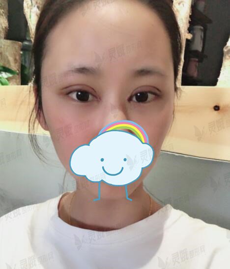 西京医院刘超华真人割双眼皮后7天