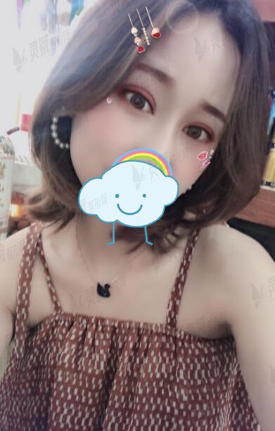 西京医院刘超华真人割双眼皮后45天