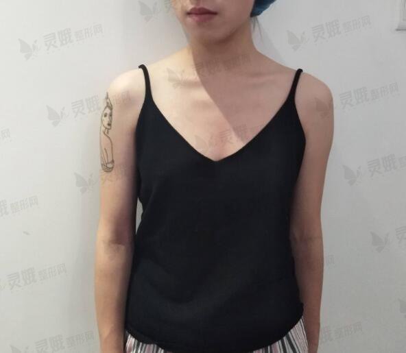 浙医二院胡学庆假体隆胸前