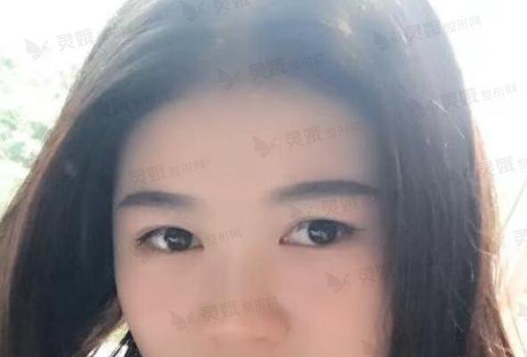 陈辉医生双眼皮修复