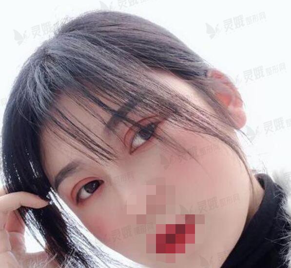 手术后
