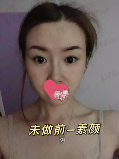 西京医院肖博开眼角前