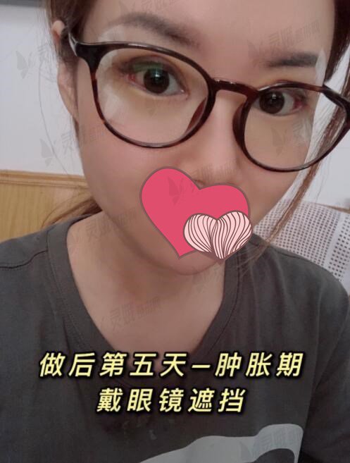 西京医院肖博开眼角后5天
