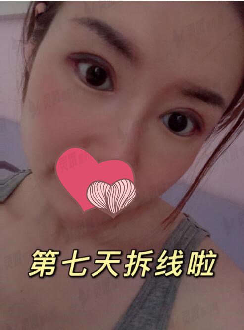 西京医院肖博开眼角后7天