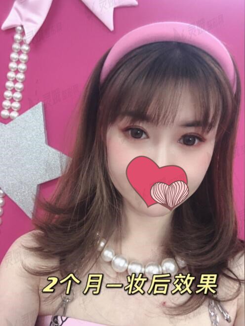开眼角手术的注意事项