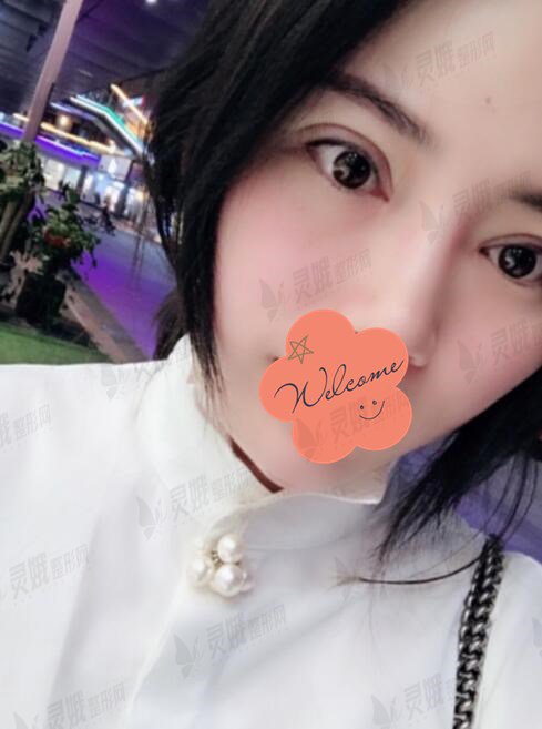 第六人民医院整形外科割双眼皮后一个月