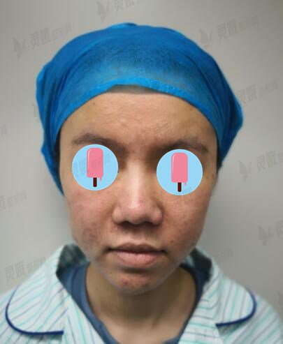 菏泽市立医院整形美容科盖红宇隆鼻前