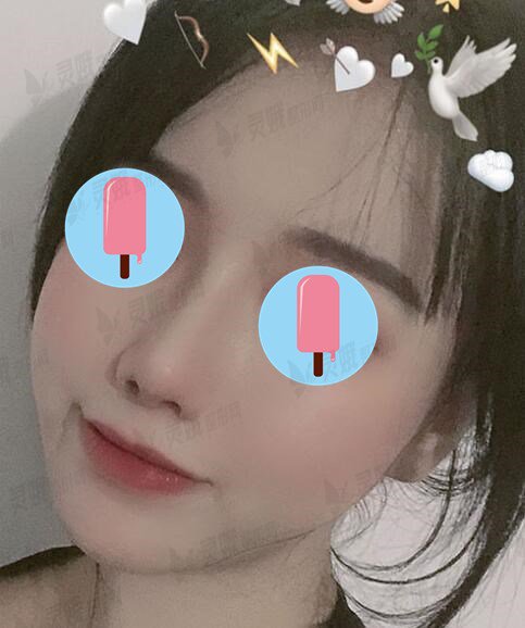 菏泽市立医院整形美容科盖红宇隆鼻后