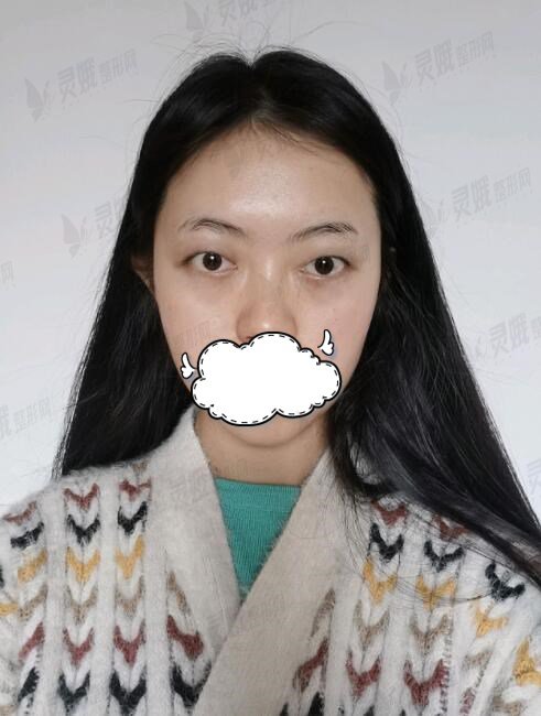 西南医院曹川医生双眼皮前