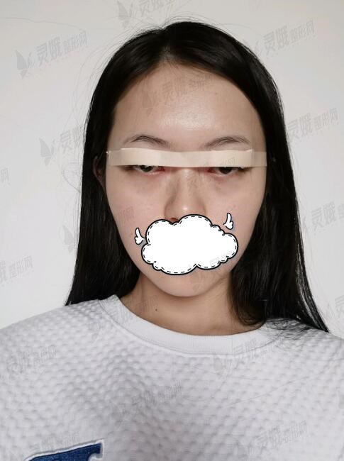 西南医院曹川医生双眼皮后一周