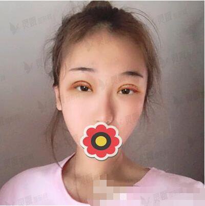 舒茂国双眼皮案例分享